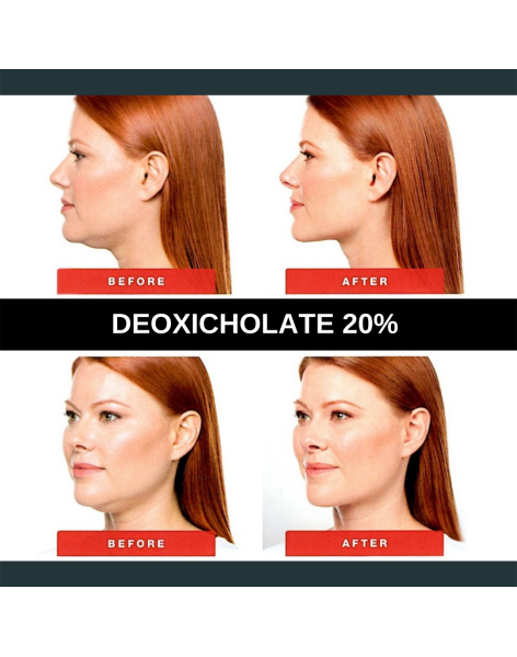 DXYPLUS 20% (deoxycholate acid) injection 20 mg/mL - 50ML  " Similar products Kybella"